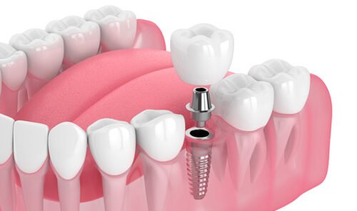 IMPLANTE DENTAL