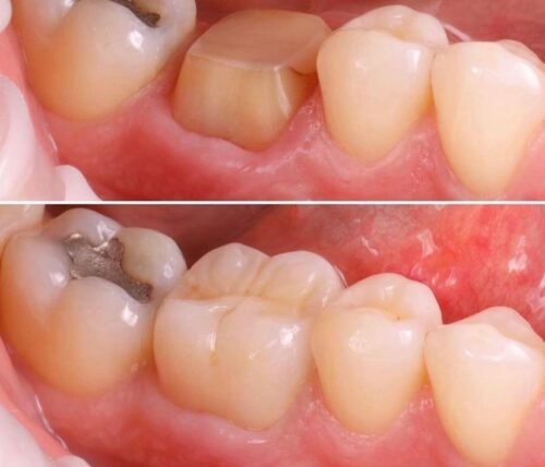 CORONA DENTAL