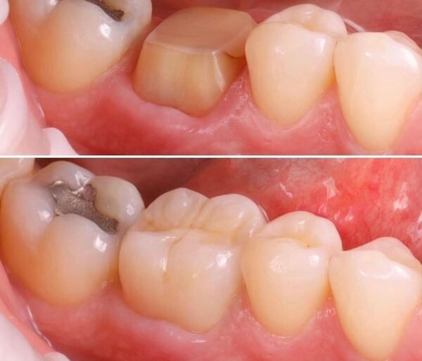 CORONA DENTAL
