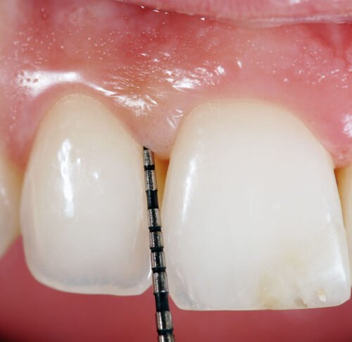 PERIODONCIA